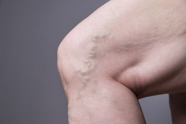 Veinas varices nas mulleres