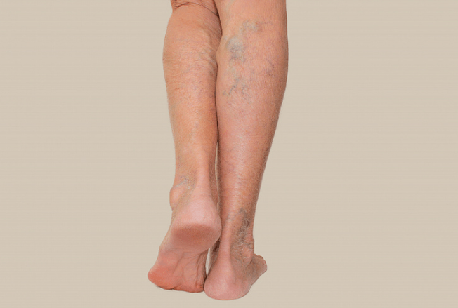 Varices nas pernas