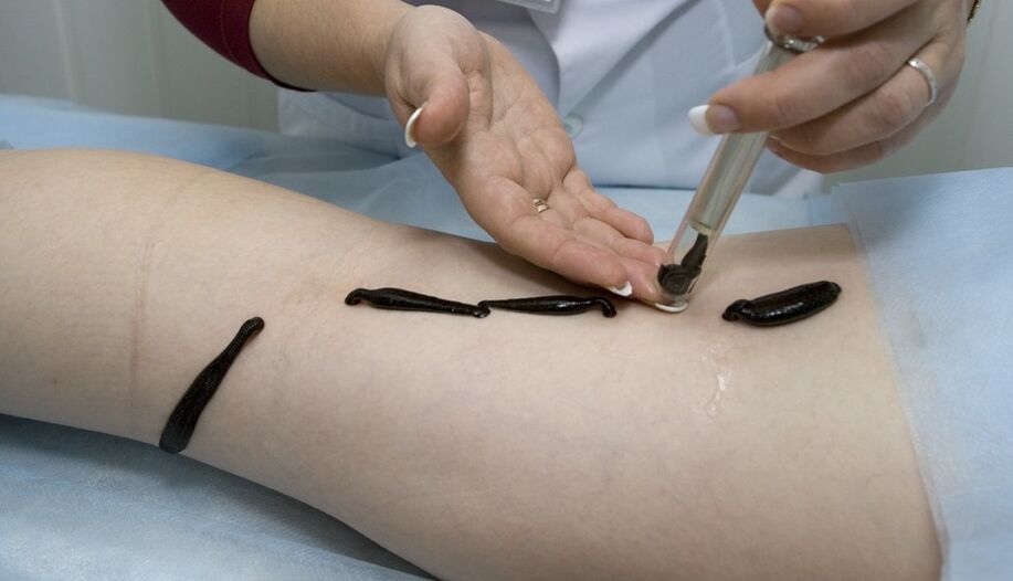 Tratamento de varices con sanguijuelas