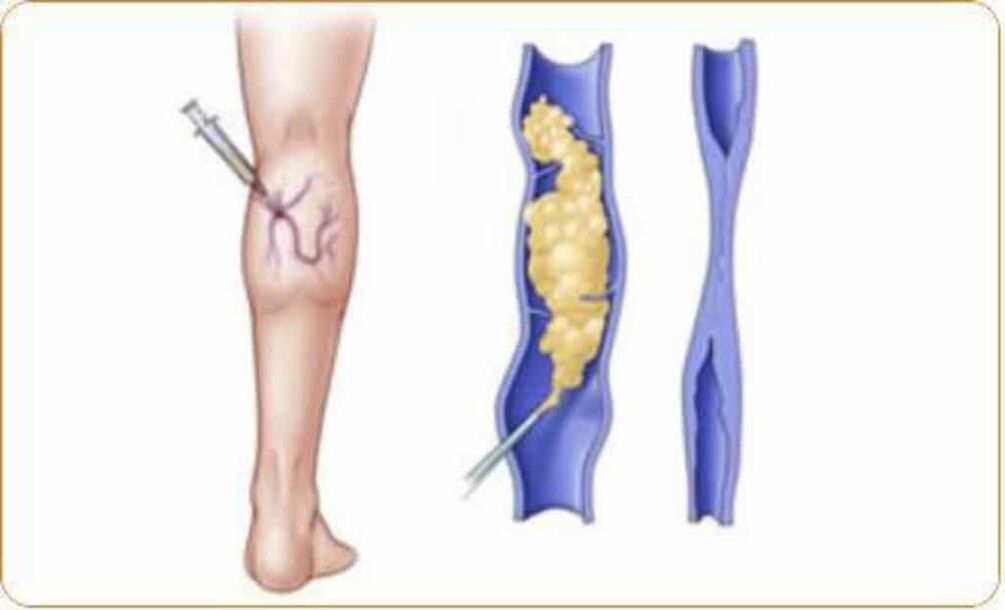 Un exemplo de escleroterapia para varices e un resultado claro