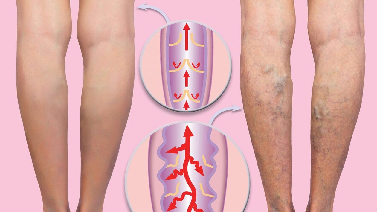 Varices nas pernas nas mulleres